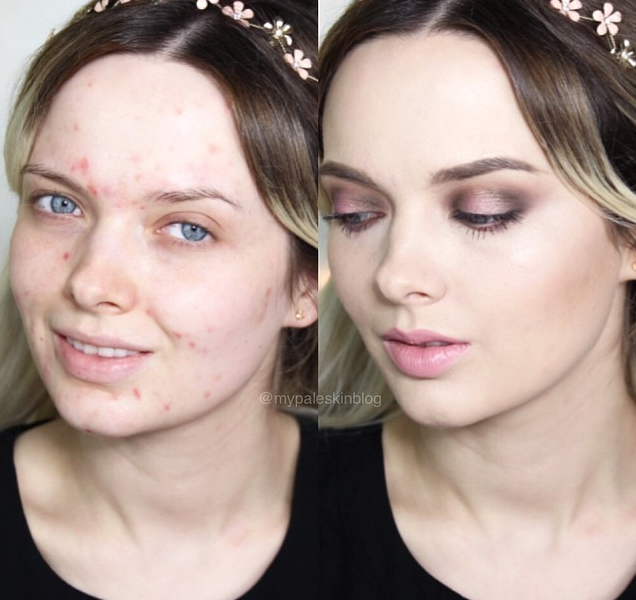 Bloguera que oculta su acné con maquillaje