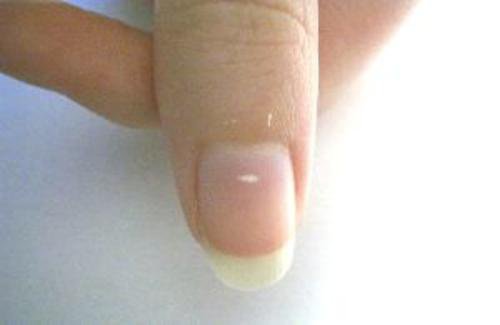 Leuconiquia, manchas blancas en las uñas