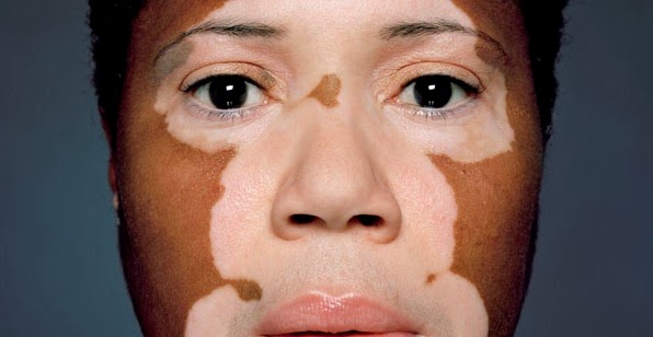 Personas con vitiligo 