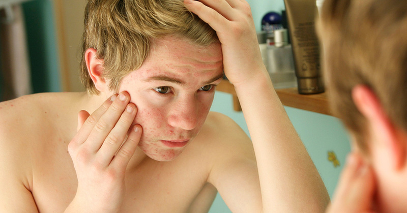 Haber sufrido acné en la adolescencia hará que envejezcas más tarde