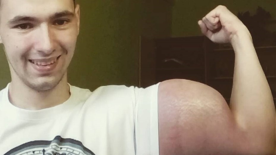“El Popeye ruso”: se inyecta “litros de aceite” para aumentar sus bíceps