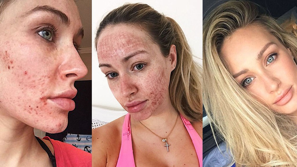 Una joven muestra asombroso resultado de un tratamiento láser contra el acné