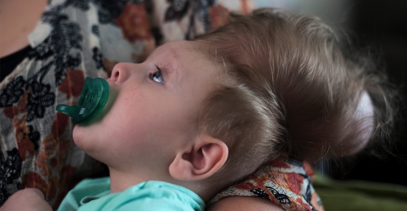 un bebe nace con el cerebro fuera 