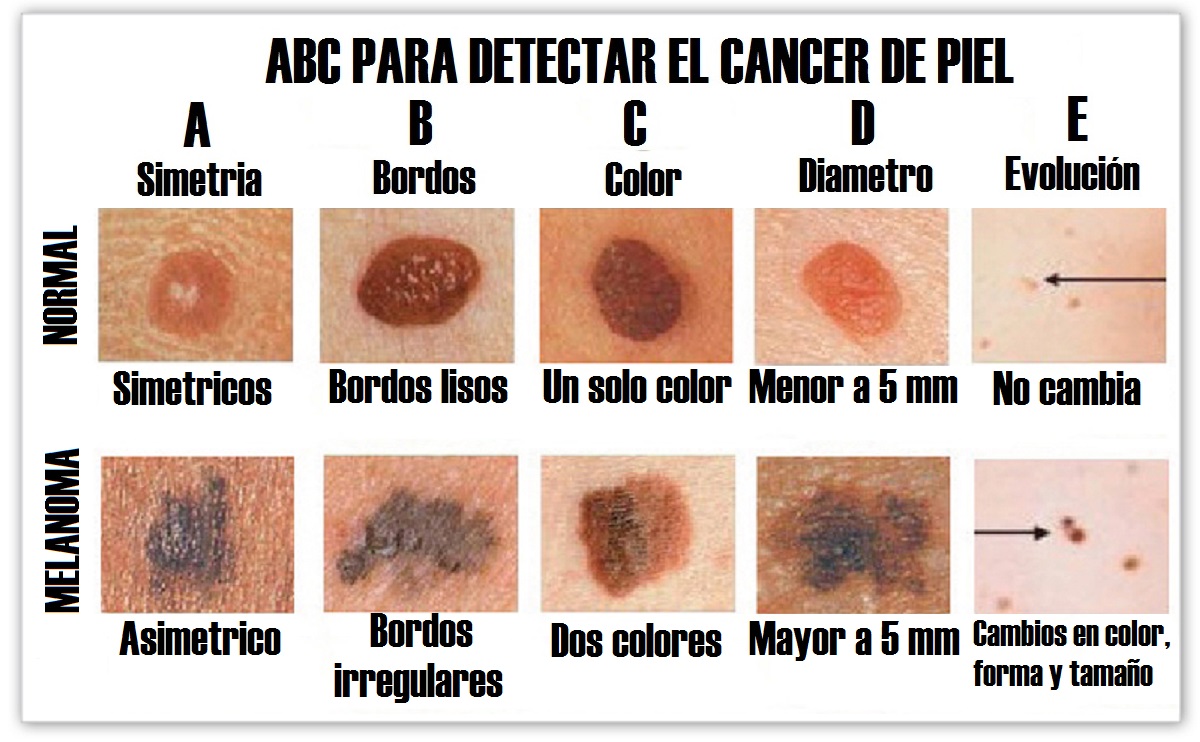 Cómo saber si tu lunar es cancerígeno