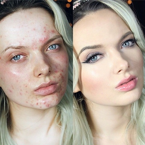 Bloguera que oculta su acné con maquillaje