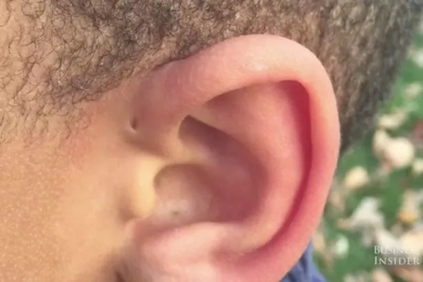 Pequeños agujeros en las orejas