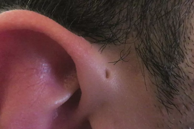 Pequeños agujeros en las orejas