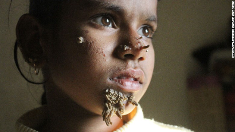 Niña con el síndrome del hombre árbol 