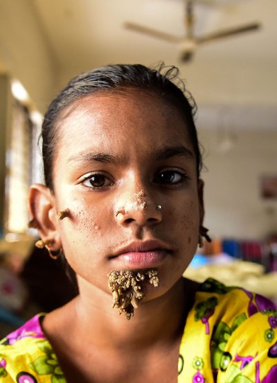 Niña con el síndrome del hombre árbol 