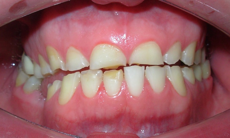 Dentaduras afectadas por el bruxismo