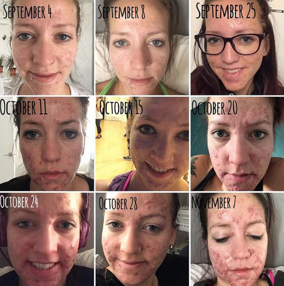 Mujer quiere visibilizar el acné en adultos 