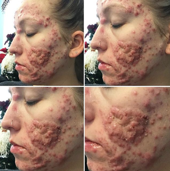 Mujer quiere visibilizar el acné en adultos 