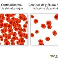 Remedios contra la anemia 