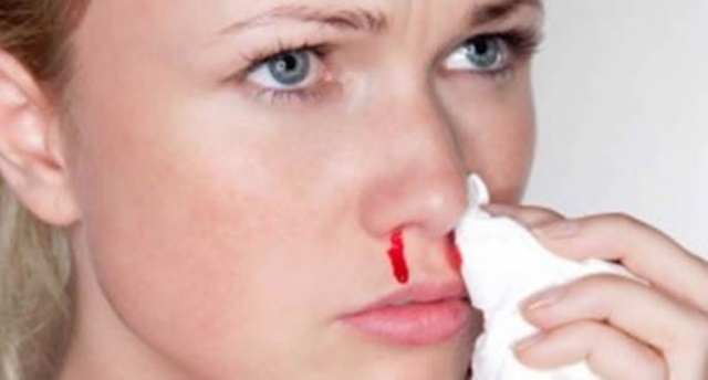 ¿Qué hacer si te sangra la nariz?