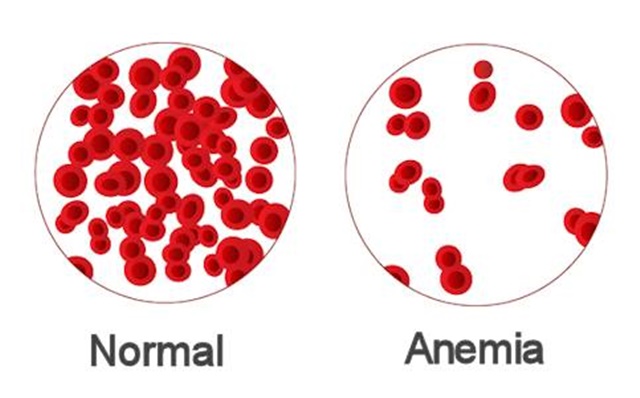 Los 10 mejores alimentos para prevenir la anemia