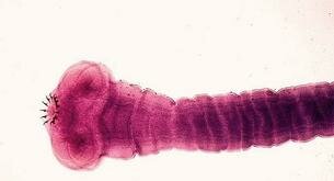 La peor enfermedad posible: Neurocisticercosis o gusanos en el cerebro