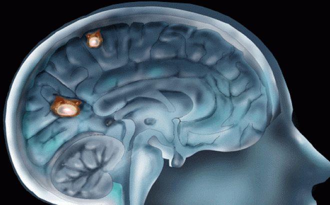 Puedes tener parásitos en el cerebro y no lo sabes Puedes tener parásitos en el cerebro y no lo sabes