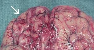 La ameba que te come el cerebro poco a poco