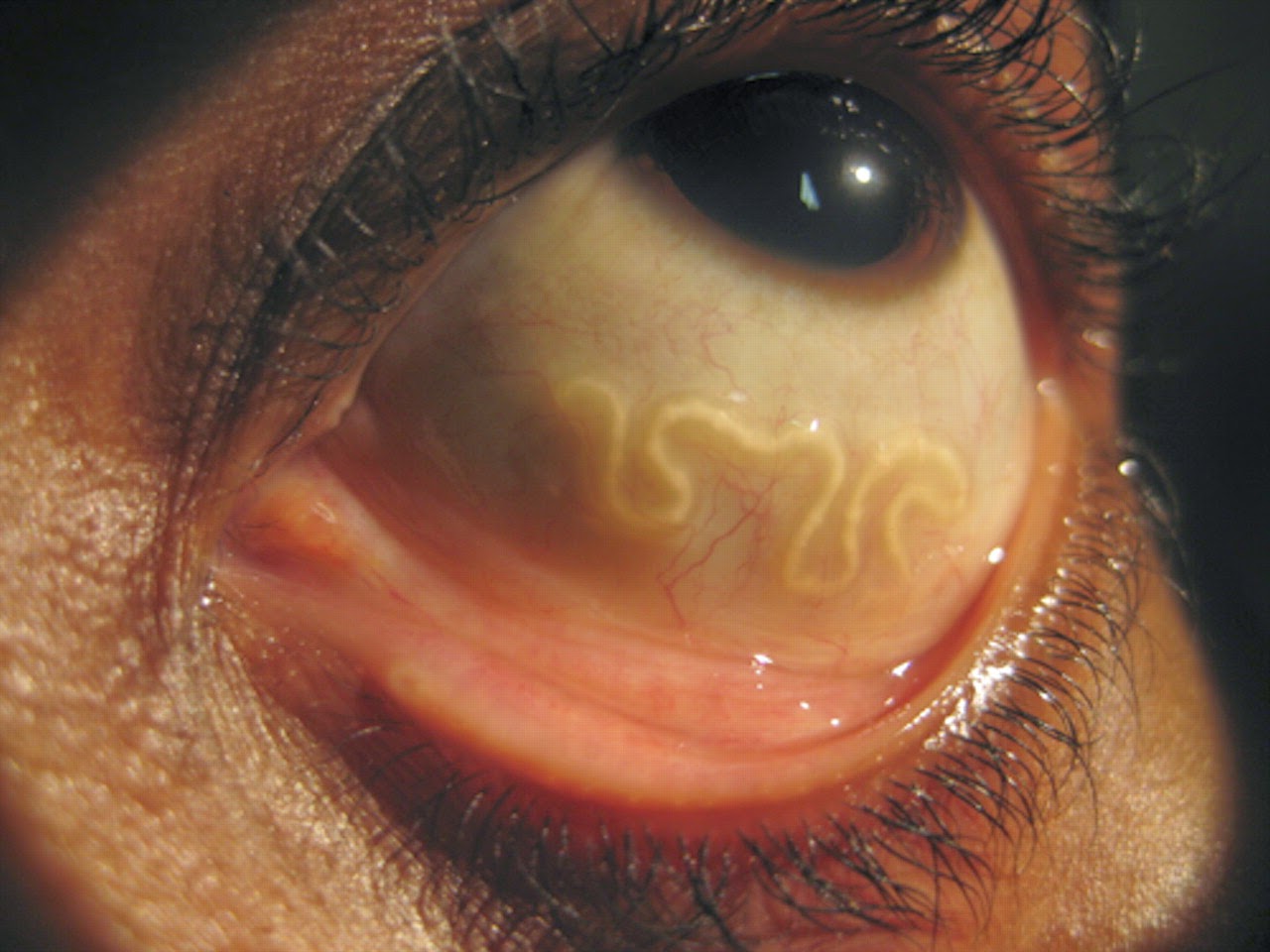 Las 5 infecciones de la cabeza m谩s terribles Las 5 infecciones de la cabeza m谩s terribles