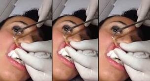 Extracción de gusano en el interior del labio superior