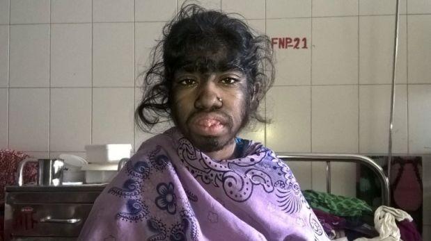 Síndrome del hombre lobo: niña de 12 años vive una tortura Síndrome del hombre lobo: niña de 12 años vive una tortura