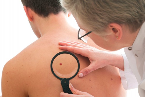Cómo saber si tu lunar es cancerígeno Cómo saber si tu lunar es cancerígeno