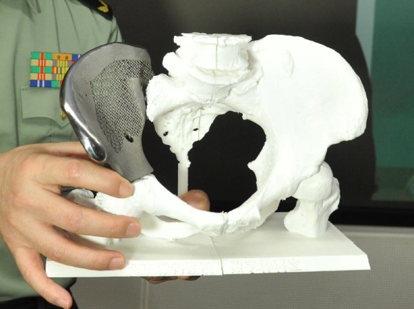 Inventan huesos artificiales impresos en 3D para reparar fracturas