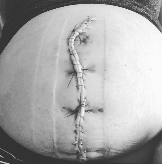 La foto viral de una cesárea que cambiará tu visión sobre esta operación