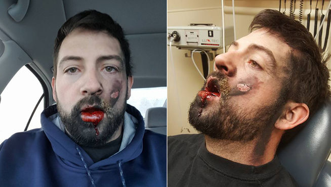 As铆 qued贸 este hombre al explotarle en la cara un cigarrillo electr贸nico As铆 qued贸 este hombre al explotarle en la cara un cigarrillo electr贸nico
