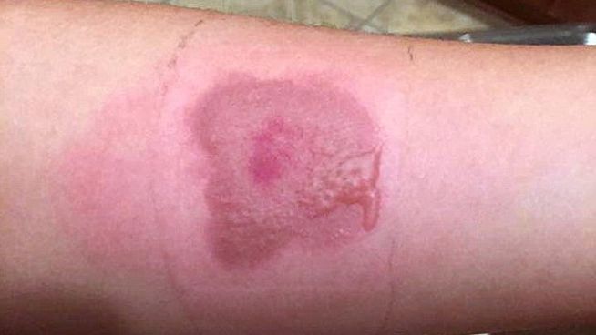 Mostrar la quemadura que te has hecho con hielo y sal: el Ășltimo viral absurdo Mostrar la quemadura que te has hecho con hielo y sal: el Ășltimo viral absurdo