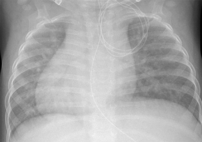 ¿Qué es la cardiopatía del 'corazón al revés'? ¿Qué es la cardiopatía del 'corazón al revés'?