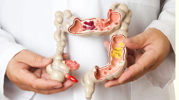 ¿Cuál es la dieta adecuada para el colon irritable?
