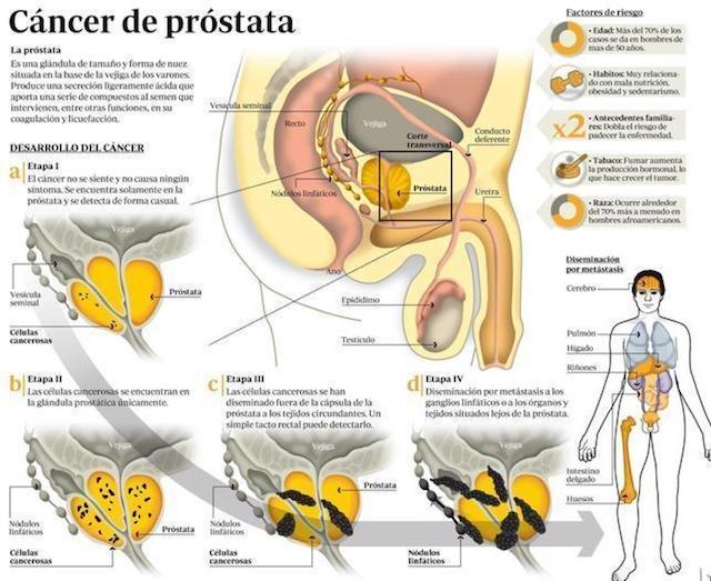  Cómo ver las señales del cáncer de próstata