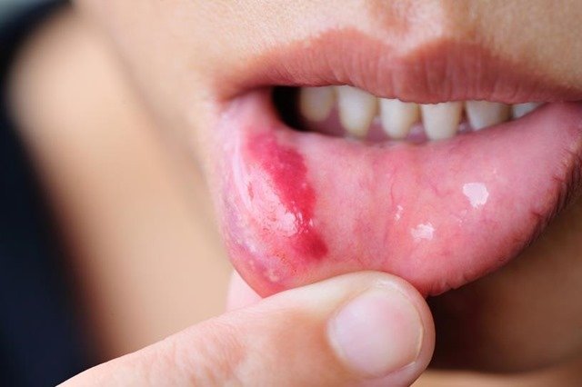 como curar llagas en la boca