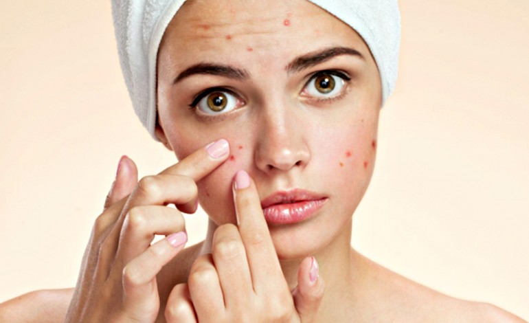 curar el acne 