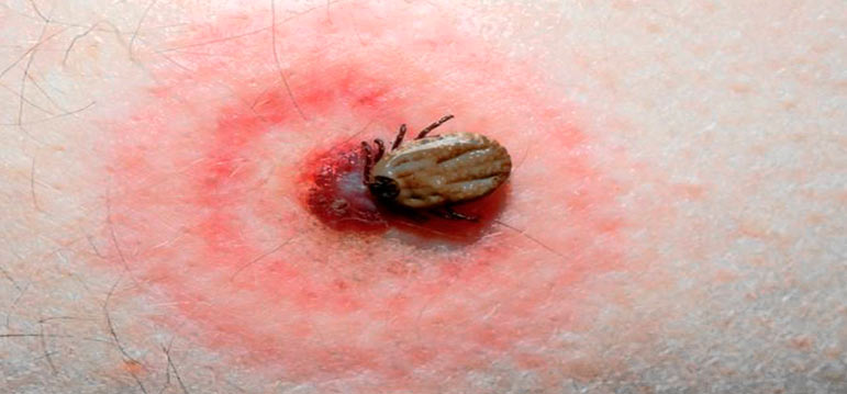¿Qué es la enfermedad de Lyme y cuáles son sus síntomas?