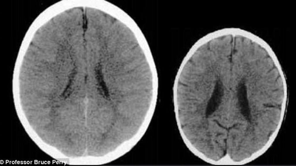 Así afecta la falta de amor al cerebro