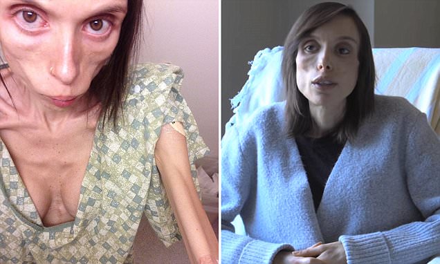 Tras sufrir anorexia durante años, suplica a los médicos que la ayuden