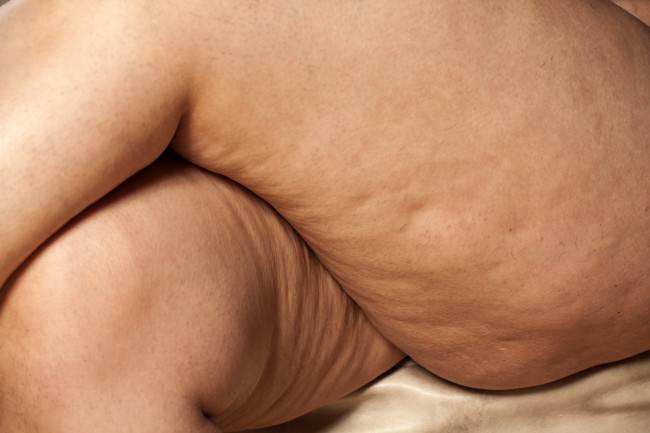 4 cosas que no sabĂas de la celulitis y que te ayudarĂĄn a eliminarla 4 cosas que no sabĂas de la celulitis y que te ayudarĂĄn a eliminarla