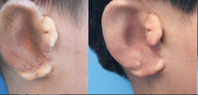 Cultivan orejas en un laboratorio para niños que nacieron sin ellas