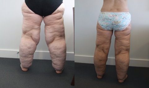 lipedema