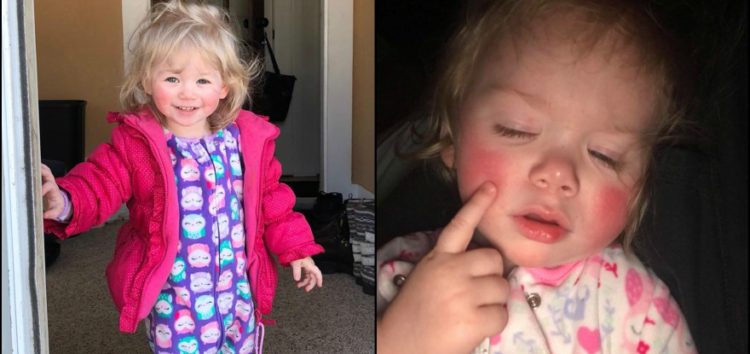 La enfermedad rara de esta niña hace que sus lágrimas le provoquen quemaduras La enfermedad rara de esta niña hace que sus lágrimas le provoquen quemaduras