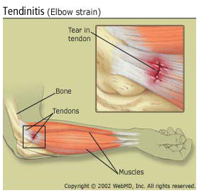 Síntomas, causas, diagnóstico, tratamiento de la tendinitis