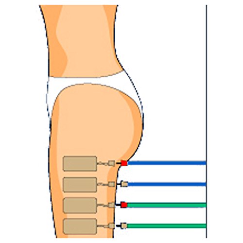 CefarCompex Cefar Compex Electrodes Stimtrode Wirep by CefarCompex Cefar Compex Electrodes Stimtrode Wirep by