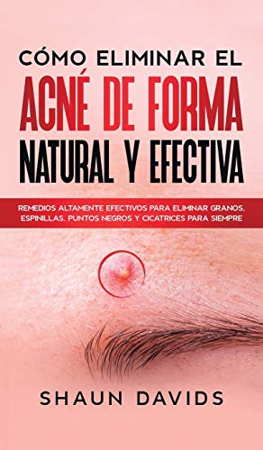 Cómo Eliminar el Acné de Forma Natural y Efectiva: Remedios altamente efectivos para eliminar granos, espinillas, puntos negros y cicatrices para siempre