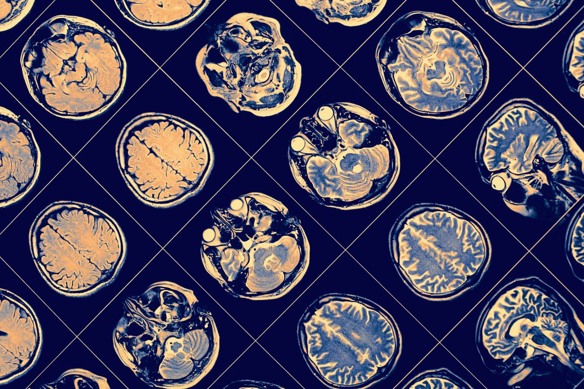 La esquizofrenia es el segundo factor de riesgo de muerte por COVID-19, después de la edad