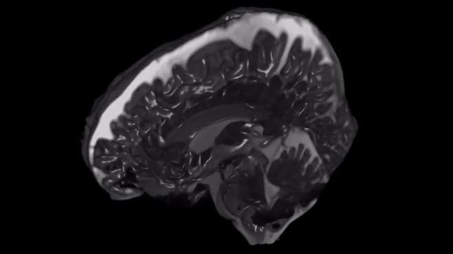 Vea cómo el cerebro se tambalea con cada latido del corazón en nuevos e increíbles vídeos