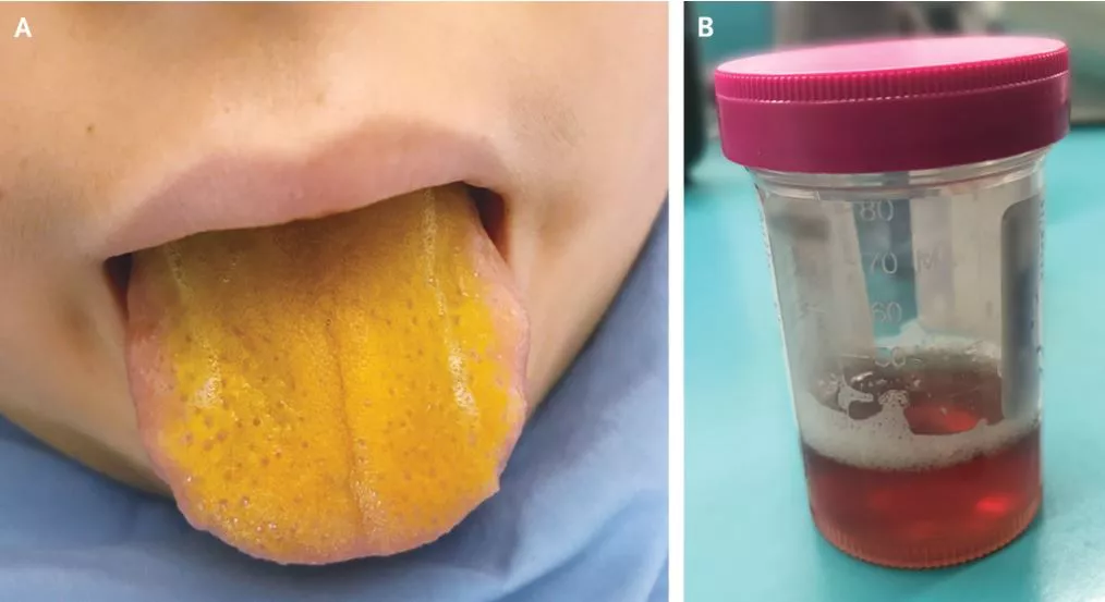 La lengua de color amarillo brillante de un niño era un signo de un raro trastorno