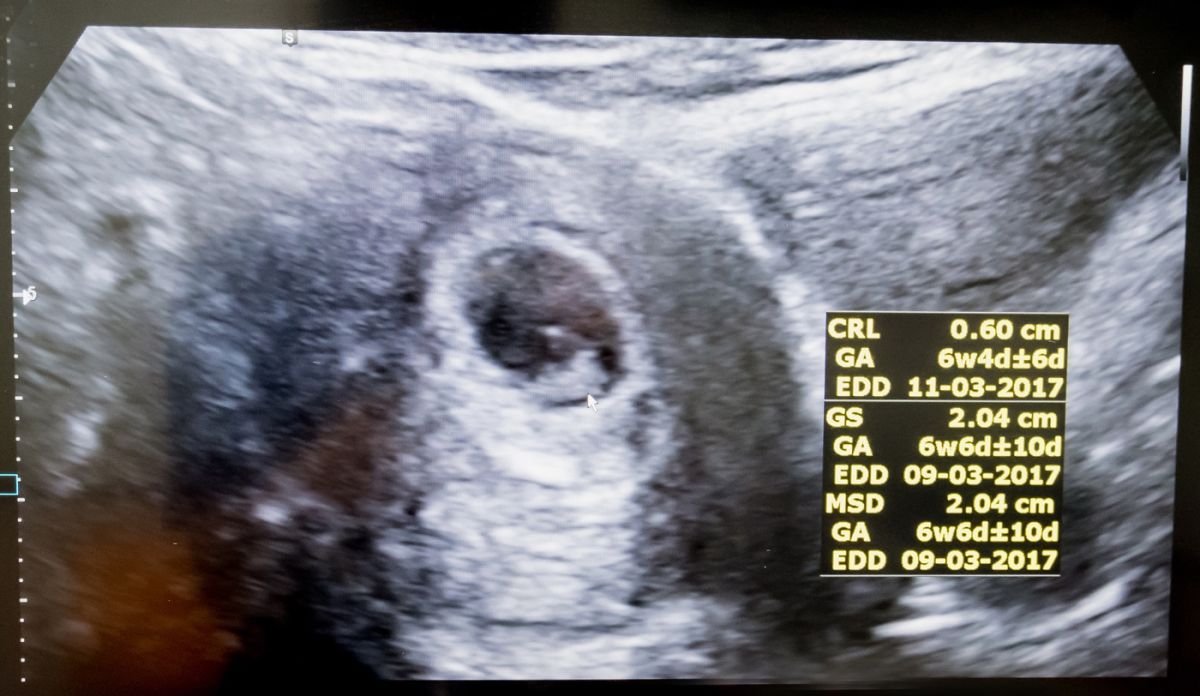 ¿Es un "latido fetal" realmente un latido a las 6 semanas?