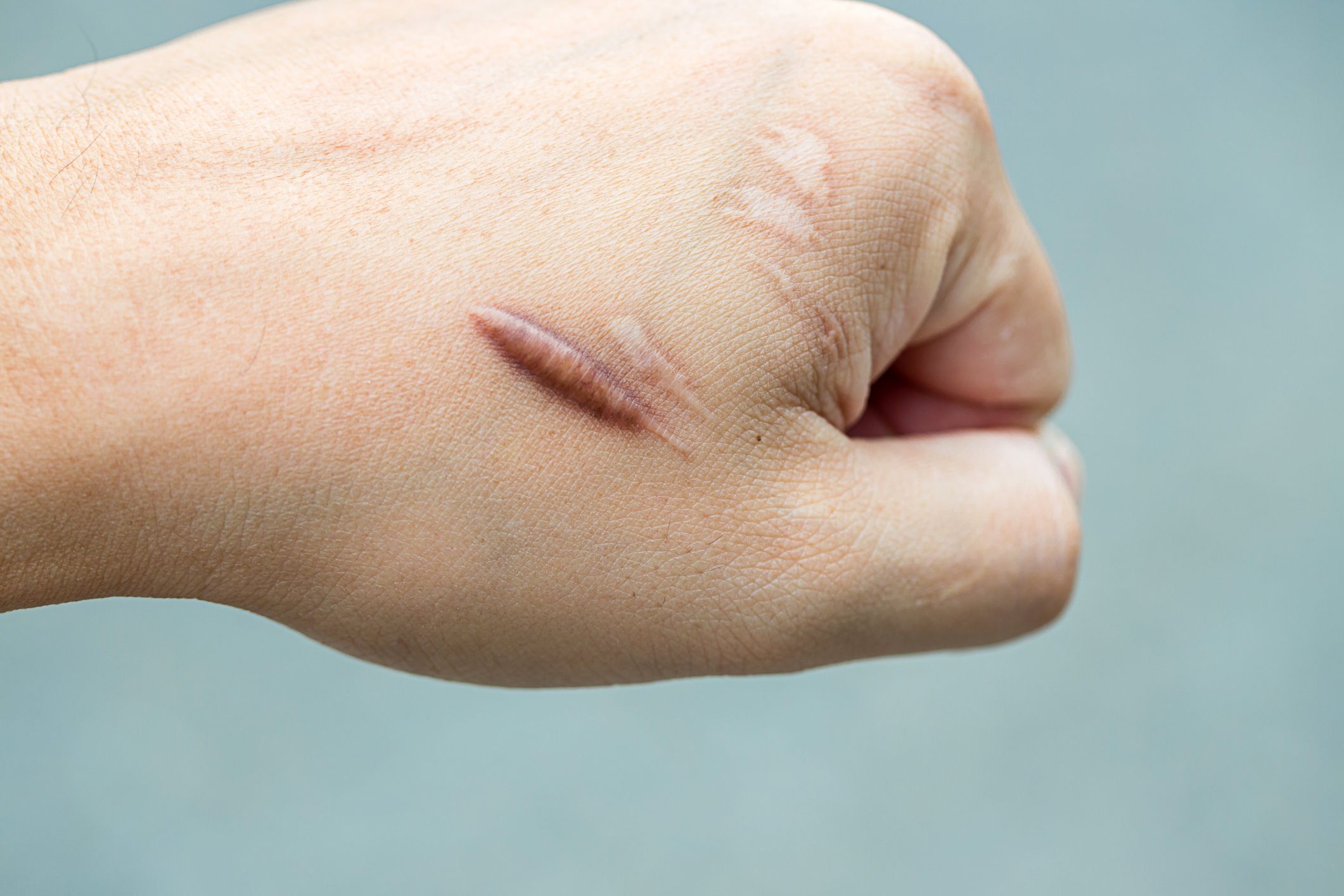 Cómo eliminar las cicatrices, según los dermatólogos